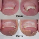 두정 | 천안 내성발톱 관리 받고 온 레푸스 천안두정점 솔직 후기