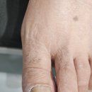 대구 내성발톱 걸을 때마다 불편했던 발 상태 편안해진 내일도네일해 후기