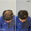 촘촘 스칼프 이미지