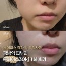 오일튠 | 강남역 피부과 튠페이스 30kj 후기와 효과 주의사항까지