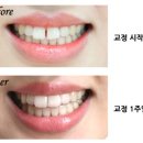 연재치과기공소 | 투명교정후기 투명교정치과 1주과정