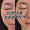 바르델 | 구미 바르델 후기 하이브리드 고주파 1회로 5년 어려지기
