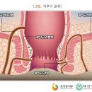 치루개 이미지