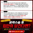 윤곽수술 후 2년이 지나도 입안이 당긴다면? 여우야 실제 후기 분석