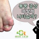 통풍에 해로운 음식 알고 계신가요 이미지