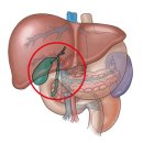 만성 담낭염 (Chronic cholecystitis) 이미지