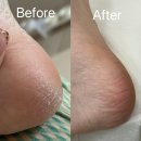 구월한방병원 | [인천 구월] 겨울철 발관리의 끝판왕 인천발관리 레푸스 구월점