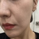 대전 울쎄라 써마지 보다 좋은 리프팅? 올타이트 리프팅 솔직후기