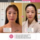 만덕1동-2 | 만덕피부관리 브이오미에스테틱 윤곽관리 받고 온 솔직후기 얼굴라인 변화