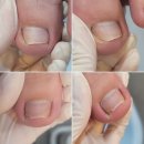 가봄네일&레푸스범어점 | 내성발톱 염증 발톱 육아종 해결 후기 :: 레푸스 신사점 김영현 원장