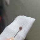 피브로한의원 | 큰점 제거 3달 후 비포애프터 - 서초 피브로 한의원 내돈내산 후기