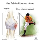 은토미술학원 | 의학 정보 시리즈: Tommy john surgery 토미존 수술ㅣ토미존ㅣ팔꿈치통증ㅣ팔꿈치내측통증ㅣ테니스 통증...
