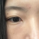 얀의원 | 얀의원 눈밑 필러, 리아이필러 2차 후기💕