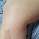 호순이 아토피 기록 (초등 산정특례) (아토피 듀피젠트 주사 2년 경과)