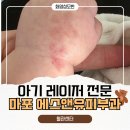 서울원피부과의원 | 아기 혈관종 화염성모반 레이저 후기 마포공덕 에스앤유 피부과 예약·주차·보험청구 총정리