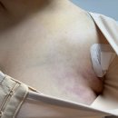 이엔바이오 | 부산팔뚝지방흡입 4개월 리얼후기 및 관리 꿀팁까지 총정리❗️