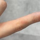 미보약국 | 미보연고 사용 후기 _ 화상연고