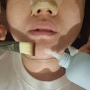 미모엔미모에스테틱 | 대구 여드름관리 제대로 받고 온 후기:) 대구피부두피탈모전문 미모에스테틱 재생관리 솔직후기