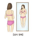 섭식장애 (Eating Disorder) 이미지