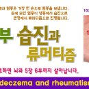 주부 습진에서 류머티즘 등 손의 염증을 치료하는 방법. 이미지