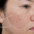 브이비비 | 여드름은 끝났는데 붉은 자국은 그대로? 대구 여드름흉터 피부과에서 브이빔퍼펙타 솔직 후기