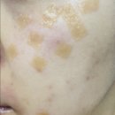 맑은윤의원 | 언남동 맑은윤 피부잡티 색소침착 레이저 후기(내돈내산)