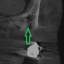 프리미어치과의원 | 임플란트는 잇몸 보강을 해야 튼튼합니다(시청역 치과의 임플란트 수술 후기)