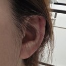 투혼타이어 | 노빠꾸 inf"P"의 6개월만에 결혼하기 (4편: 시술-람스, 필러, 지방분해주사, 마운자로)