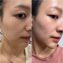 강남 논현역 피부과 레이저 프리미엄 후기 – 시네마의원에서 받은 색소 관리