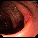 [하부소화관] 아메바성 장염 이미지