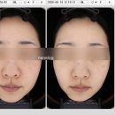 강남역 한의원 기미 주근깨 제거 3회차 대만족 후기