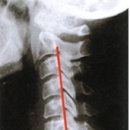 경추 증후군(CERVICAL SYNDROME) 이미지