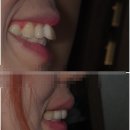 베스테크치과기공소 | 비뚤어진 앞니, 위치가 안좋은 앞니는 교정해야 이뻐집니다. 교정말고 깎아서 만든 심미치료 지르코니아...