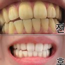 미백 | 당산 치과 원데이 치아미백 후기 화이트닝 시술 변화 솔직후기