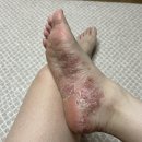 진보약국 | 반질크림 액상형 우레아 스프레이 반질올크림 각질무좀 후기