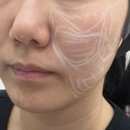 디파인 | 신사피부과 온다리프팅 브이디파인 리프팅후기 20대 얼굴형관리 장단점 솔직후기