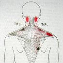 승모근(Trapezius Muscle)의 근막통증후군 이미지