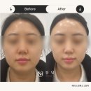 이디야커피전주에코로마네시티점 | 전주 스킨플라청담 이중턱고민인분들에게 추천드리는 페이스핏톡스 후기