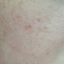 성성하나로약국 | 멜라논크림 색소침착 약국 사용후기