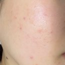 아그네스 | 인천 무제한 아그네스 레이저 후기 여드름 아그네스 효과 통증 가격