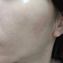 광화문피부과 엑소좀리파인 하이쿡스 2주 후기 모공관리방법