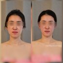 라라금 | 라라뷰티스파 | 표정을 예쁘게 만드는 JH윤곽술 메타버전 후기