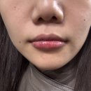 오렌지의원 | 서면 블리비의원 입술 필러 1,2회차 내돈내산 후기
