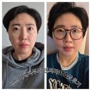 성신사우나 | 성신여대피부과 고주파리프팅 종류 텐써마 300샷 으로도 충분할까?