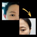 정자역3번출구 | 정자역 피부과 싹뺀다 프로그램으로 비립종, 편평사마귀, 피지 한번에 제거한 후기