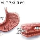 위장관출혈 원인 및 (위출혈 , 대장출혈) 이미지