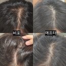 강호전기조명 | 압구정 헤어라인 탈모치료 헤어셀, 모낭주사 2회차 후기
