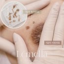 관악 색소침착 갈색 유륜 미백관리 / 핑크 유륜 케어 르멜라 제이앤뷰티