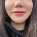 프레쉬홍닥터의원 | 프레쉬홍닥터에서 앞광대 지방흡입 시술후기 (내돈내산)