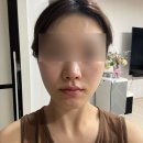 보민스킨케어 | 대전피부과 텐써마 레이저리프팅 300샷 2주간 상세 후기